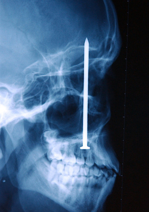 A nail embedded in the skull of a man after he accidentally shot himself with a nail gun. He didn’t even realize he had been shot until 6 days later when the four-inch nail was discovered.