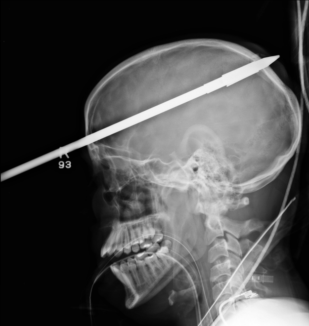 A spear lodged in the skull of a 16-year-old boy. One of the boy’s friends was loading a speargun when it accidentally fired.