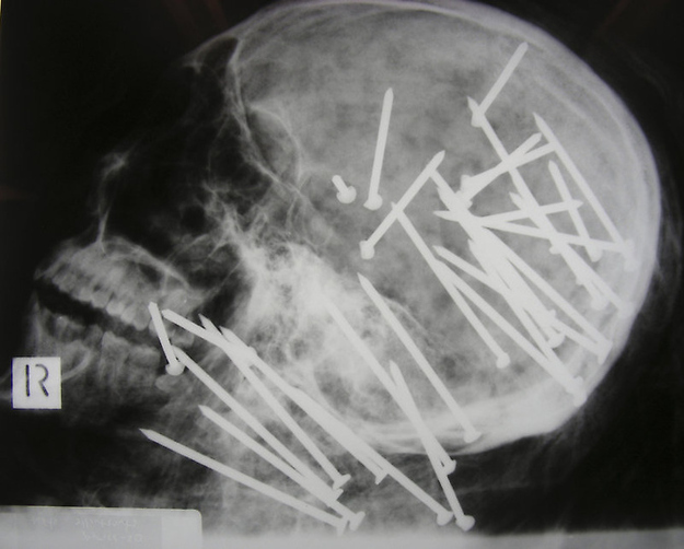 The skull of Chinese man who was shot in the head with a high-powered nail gun.